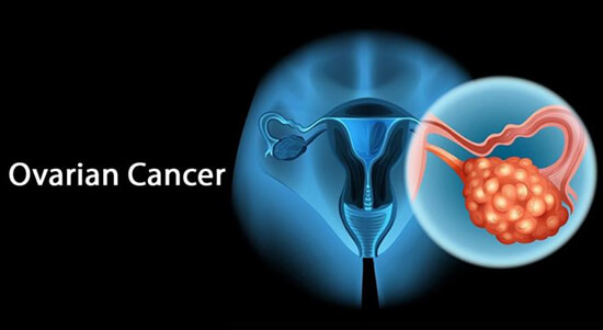  Understanding Ovarian Cancer Cancer Control Mission
